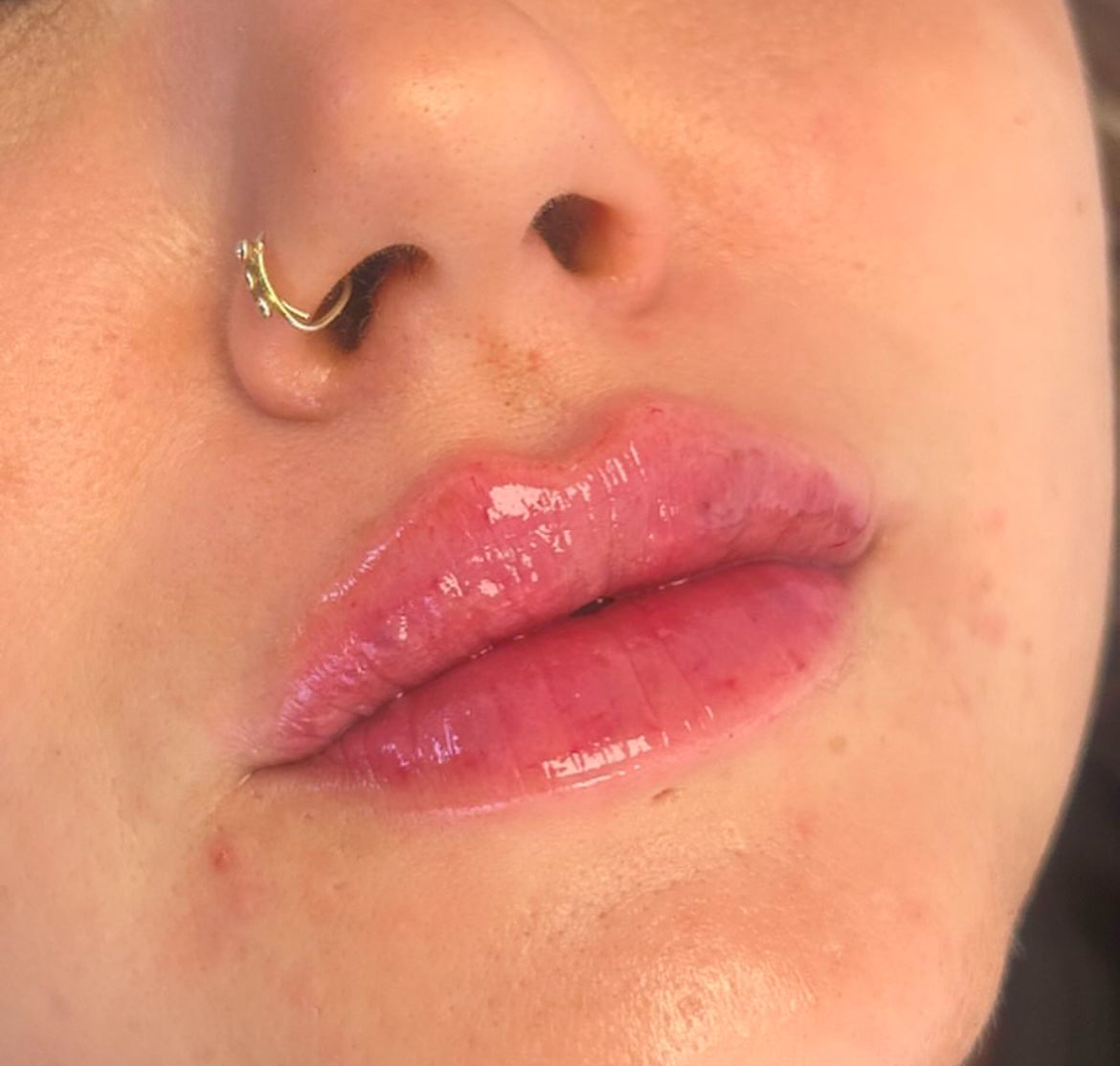 Normal 1.7 Lip Filler