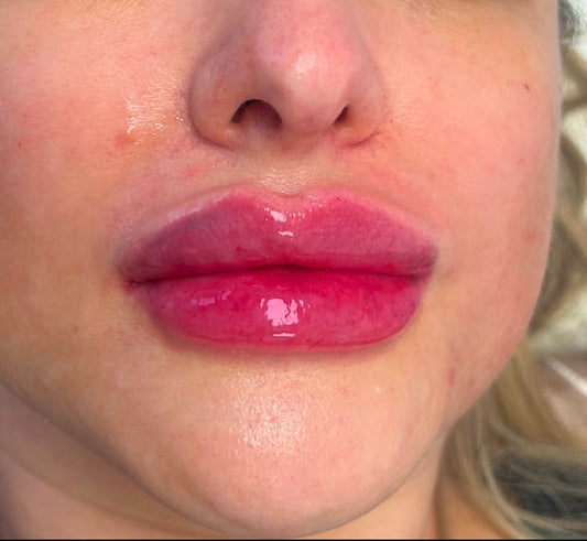 Russian Lip Filler 2.2ml