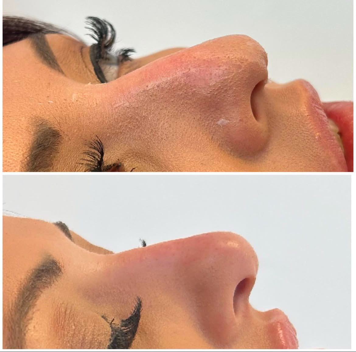 Facial Filler Non Surgical Rhinoplasty 0.5ml