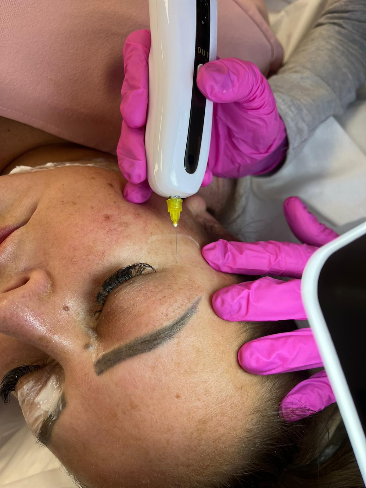 Plasma Fibroblast Skin Tightening Training Course - 1 Day